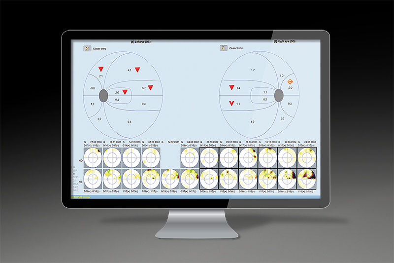 EYESUITE GLAUCOMA ANALYSIS