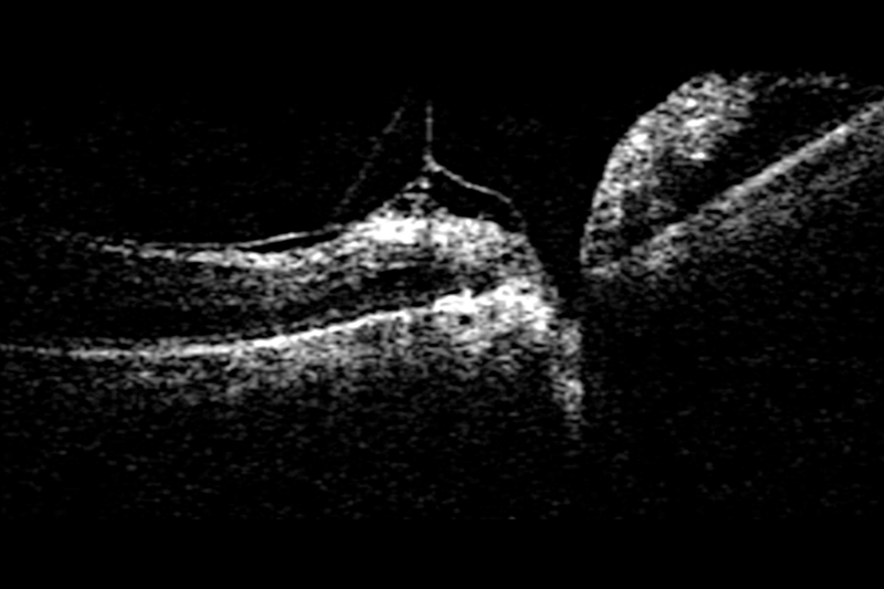 POSTERIOR SEGMENT SURGERY