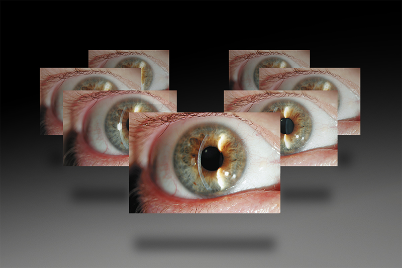 SLIT LAMP IMAGING